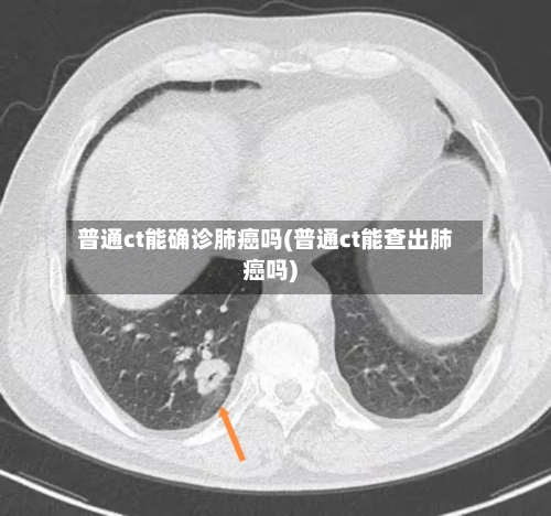 普通ct能确诊肺癌吗(普通ct能查出肺癌吗)-第2张图片