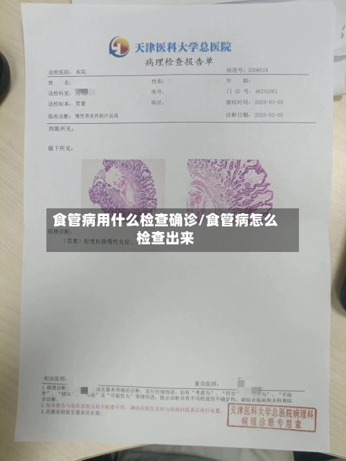 食管病用什么检查确诊/食管病怎么检查出来