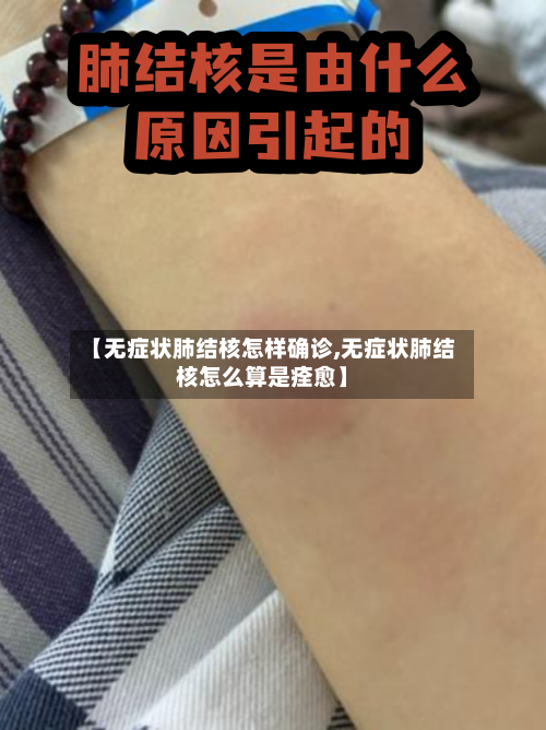 【无症状肺结核怎样确诊,无症状肺结核怎么算是痊愈】-第2张图片