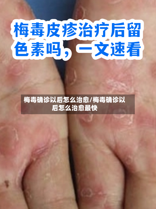 梅毒确诊以后怎么治愈/梅毒确诊以后怎么治愈最快-第3张图片