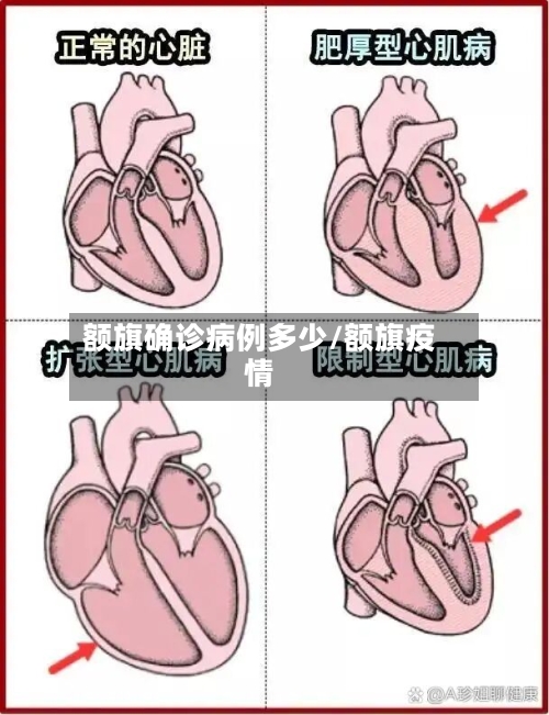 额旗确诊病例多少/额旗疫情
