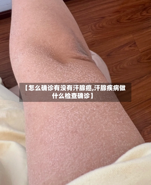 【怎么确诊有没有汗腺癌,汗腺疾病做什么检查确诊】
