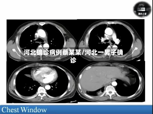 河北确诊病例蔡某某/河北一男子确诊-第3张图片