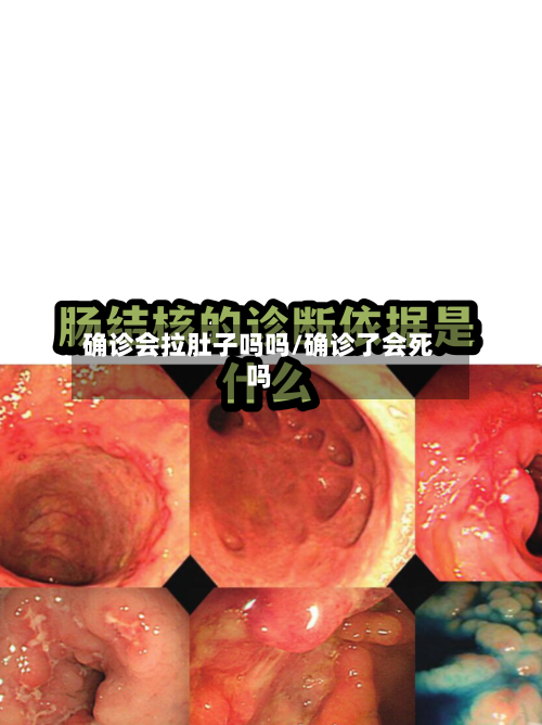 确诊会拉肚子吗吗/确诊了会死吗-第3张图片