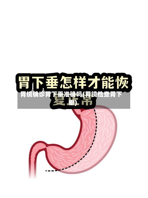 胃镜确诊胃下垂准确吗(胃镜检查胃下垂)