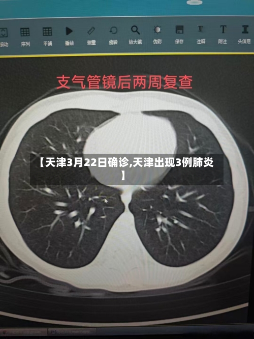 【天津3月22日确诊,天津出现3例肺炎】-第3张图片