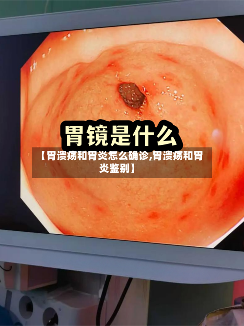 【胃溃疡和胃炎怎么确诊,胃溃疡和胃炎鉴别】