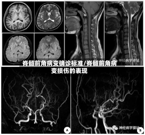 脊髓前角病变确诊标准/脊髓前角病变损伤的表现