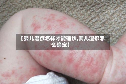 【婴儿湿疹怎样才能确诊,婴儿湿疹怎么确定】-第2张图片
