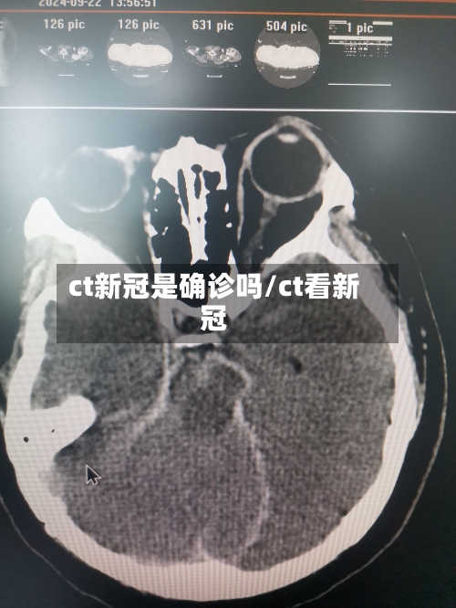 ct新冠是确诊吗/ct看新冠-第2张图片