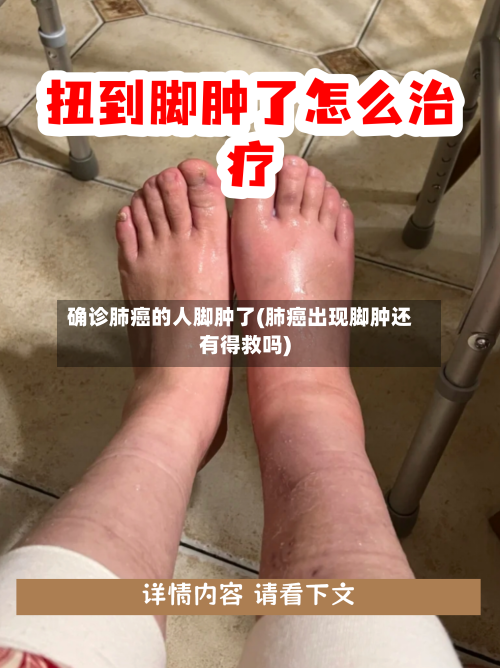 确诊肺癌的人脚肿了(肺癌出现脚肿还有得救吗)-第3张图片