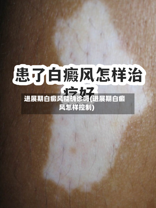 进展期白癜风能确诊吗(进展期白癜风怎样控制)-第2张图片