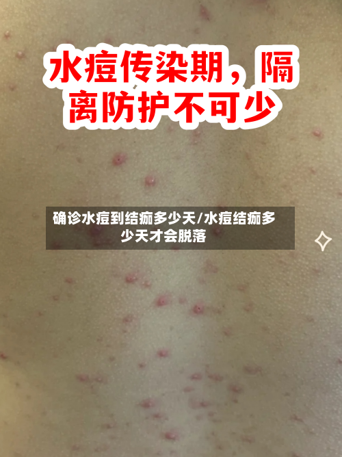 确诊水痘到结痂多少天/水痘结痂多少天才会脱落-第3张图片