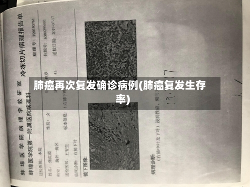 肺癌再次复发确诊病例(肺癌复发生存率)