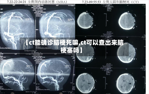 【ct能确诊脑梗死嘛,ct可以查出来脑梗塞吗】