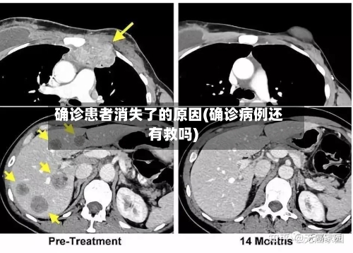 确诊患者消失了的原因(确诊病例还有救吗)