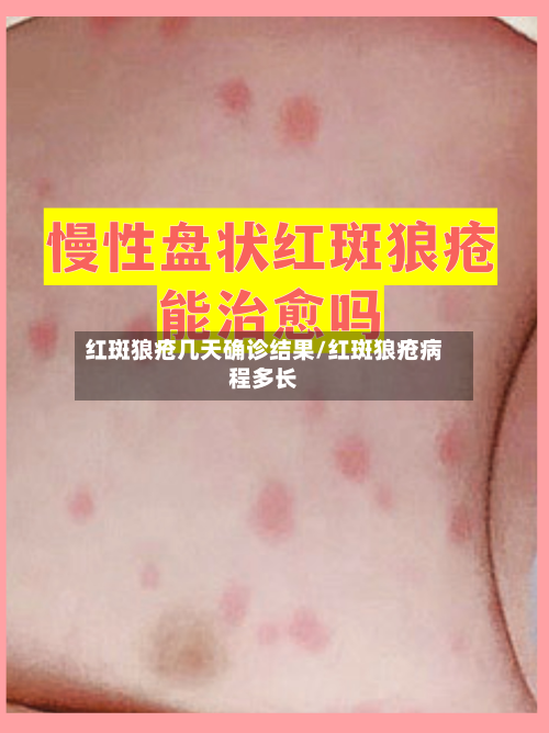 红斑狼疮几天确诊结果/红斑狼疮病程多长