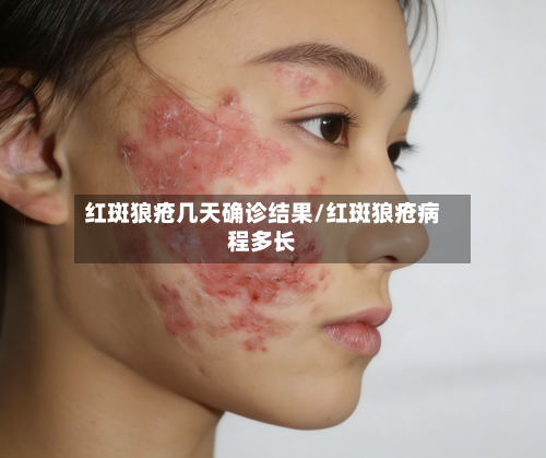 红斑狼疮几天确诊结果/红斑狼疮病程多长-第3张图片