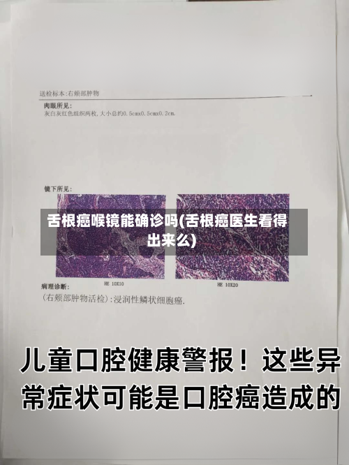 舌根癌喉镜能确诊吗(舌根癌医生看得出来么)